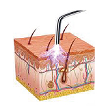 Rajeunissement cutanée